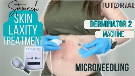 Loose Stomach Skin Tightening Guide Derminator 2 Microneedling Youtube