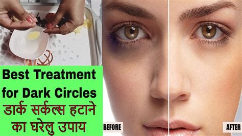 Best Home Remedy For Dark Circles In Hindi Kale Ghere Hatane Ke