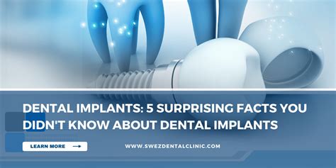 Dental Implants 5 Surprising Facts You Didn T Know About Dental