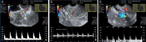 Measurement Of The Doppler Indices A Uterine Artery B Arcuate Download Scientific Diagram