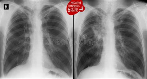 X-ray of the Lungs: Operated Lung. Escalation Tuberculosis of the Lungs after 6 Months. Negative ...