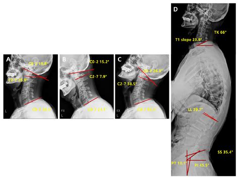 Jcm Free Full Text Analysis Of Cervical Spine Alignment And Its Relationship With Other