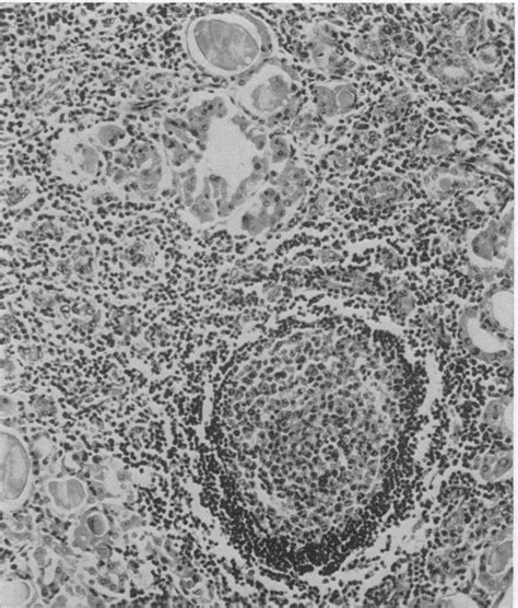 Struma Lymphomatosa Hashimotos Thyroiditis — Observations On