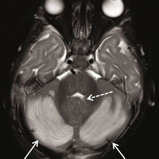 Mri At The Time Of Presentation A Axial T Weighted Image Shows