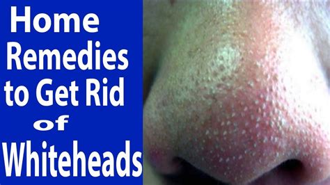 How To Get Rid Of Whiteheads Naturally How To Remove Whiteheads At