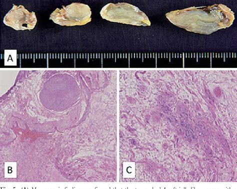 Figure From A Case Of Intrathoracic Beaded Schwannomas Originating