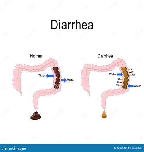 Diarreia E Disenteria Ilustração Do Vetor Ilustração De Anatomia