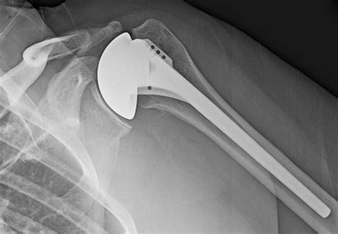 Shoulder And Elbow Surgery Shoulder Resurfacing Hemi Arthroplasty Or