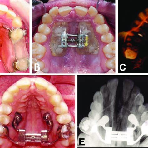 A: Hyrax expander with a metal framework anchored to the dentition ...