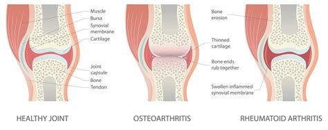 Osteoarthritis Vs Rheumatoid Arthritis Know The Difference