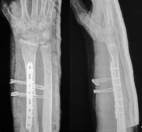 Anteroposterior A And Lateral B Radiographs At 6 Month Follow Up