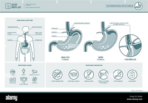 La enfermedad de reflujo ácido acidez estomacal y Gerd infográfico con