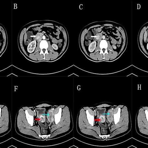 Upper Lower Abdomen Pelvic Cavity Enhanced CT A And E Plain Scan B