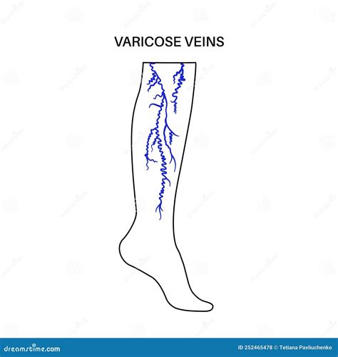 Varicose Veins Treatment Stock Vector Illustration Of Body 252465478