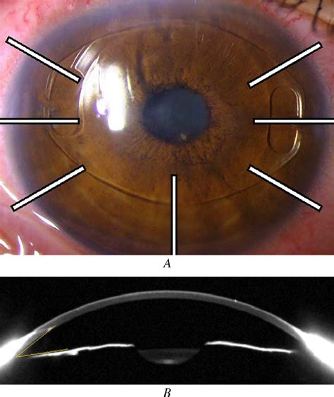 Figure From Alterations In The Anterior Chamber Angle After