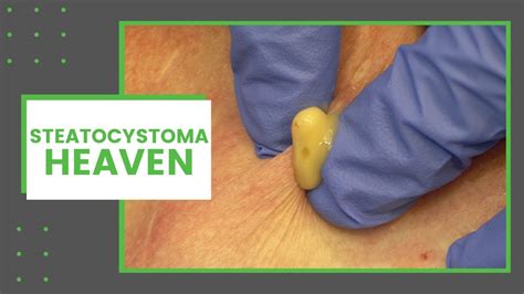 Steatocystoma Dr Derm Pop That Zit Since 2006