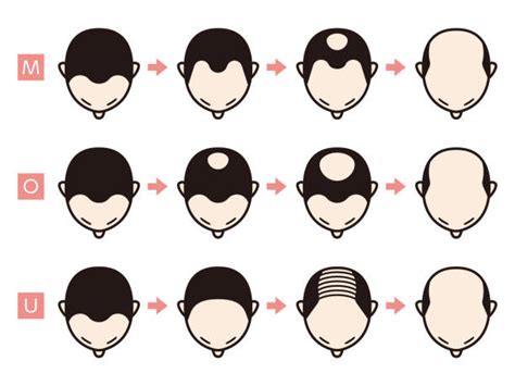 Receding Hairline Styles Illustrations Royalty Free Vector Graphics