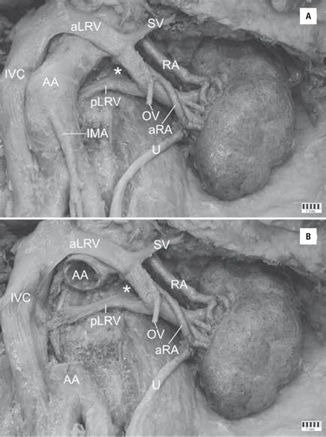 Figure 1 From Circumaortic Left Renal Vein Circumaortic Renal Collar