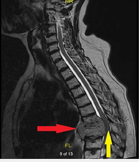 Plasmacytoma With Spinal Cord Compression Sagittal View Of Thoracic