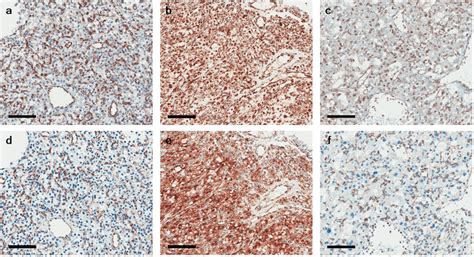 Sdhb Immunohistochemistry Of Hemangioblastoma With Two Different Download Scientific Diagram