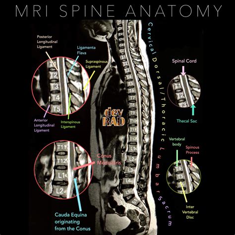 Cervical Spine Mri Labeled