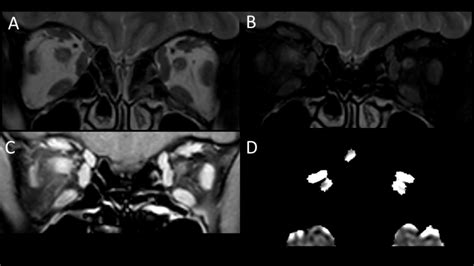 Normal extraocular muscles. Coronal T2-weighted MRI (A) demonstrating ...