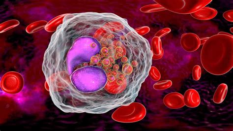 Chronic eosinophilic leukemia: symptoms, diagnosis and treatment