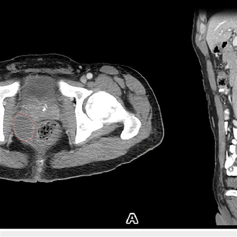 A Axial And B Sagittal Ct Scan At The Follow Up Interval After