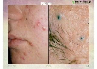 Most Common Skin Diseases Drx Tonisingh Ppt