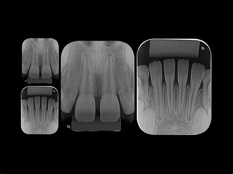 Radiografia Periapical Cadi Centro Avan Ado De Diagn Stico Por Imagem