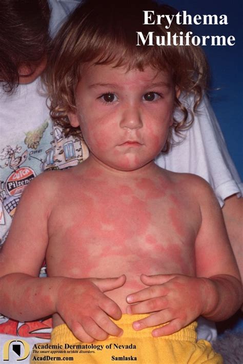 Erythema Multiforme Erythema Exudativum Multiforme Academic Dermatology Of Nevada