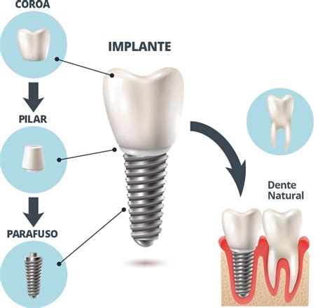 Implante Dentario Pr Teses Enleva Odontologia Integrada