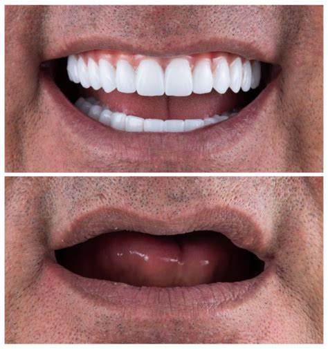 Ceramic Dental Implants In Mexico Mexicodent