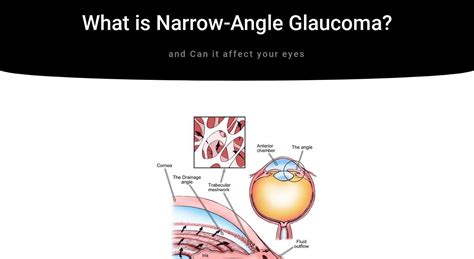 What Is Narrow Angle Glaucoma Iristech