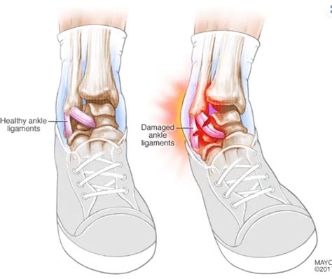 The Common Ankle Sprain: Syamak Yamini, DPM, FACFAS: Podiatrist