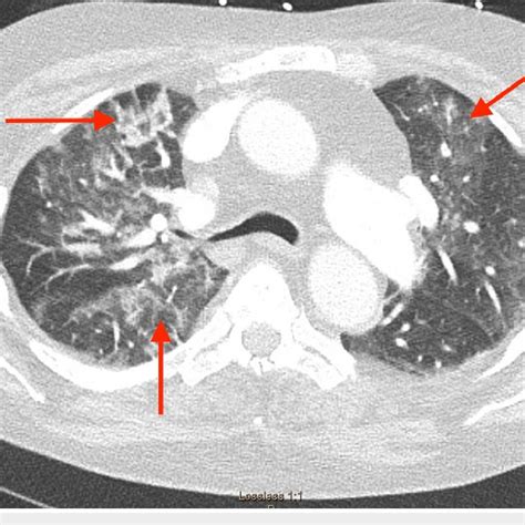 Axial Contrast Enhanced Ct Chest Lung Window Showing Bilateral