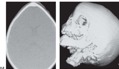 Pathology And Radiology Neupsy Key