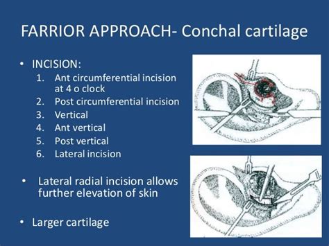 Harvesting cartilage for cartilage tympanoplasty