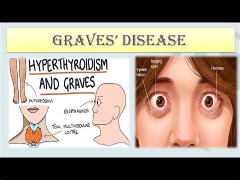 What Is Graves Disease Graves Disease Symptoms Pathophysiology Of