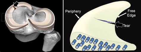 Mr Imagingbased Diagnosis And Classification Of Meniscal Tears