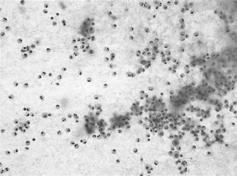 Figure 1 From A Case Of Eosinophilic Gastroenteritis Presenting As