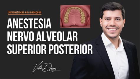 Anestesia Bloqueio Do Nervo Alveolar Superior Posterior E Nervo