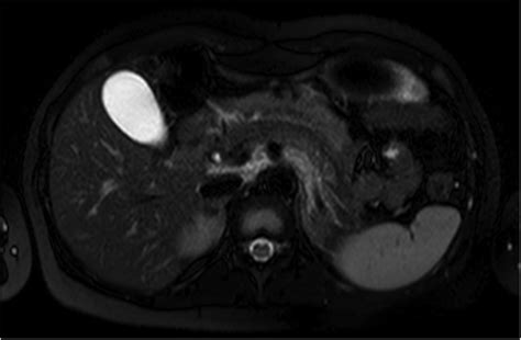 Retroperitoneal Panniculitis Bmj Case Reports