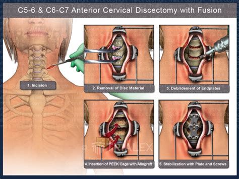 Cervical Discectomy And Fusion