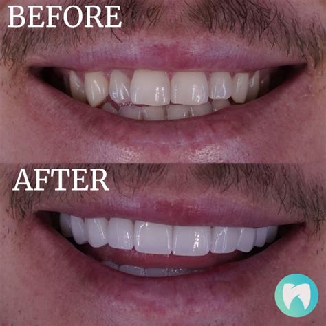 Best Price And Quality Veneers In Turkey Types Reviews