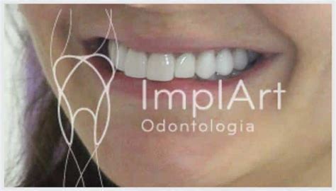 Lente Contato Dental 26kb ImplArt