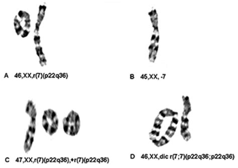 Molecular Cytogenetic Analysis And Clinical Manifestations Of A Case