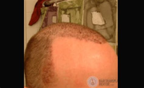 Hair Transplant Recovery; Is This Normal??? - Hair Transplant Mentor