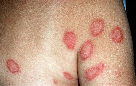 Dermatitis Contact Atopic Perioral Nummular Seborrheic Stasis