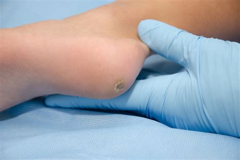 Plantar Wart Removal — Beaver Valley Foot Clinic